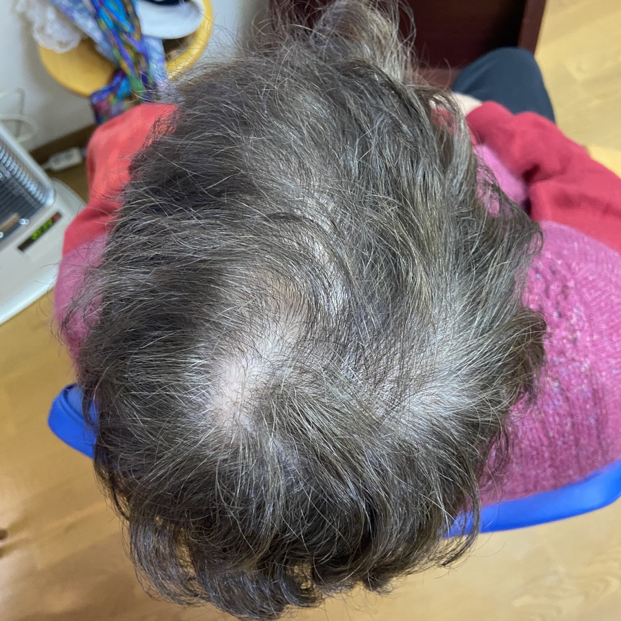 80代女性の頭頂部Before画像