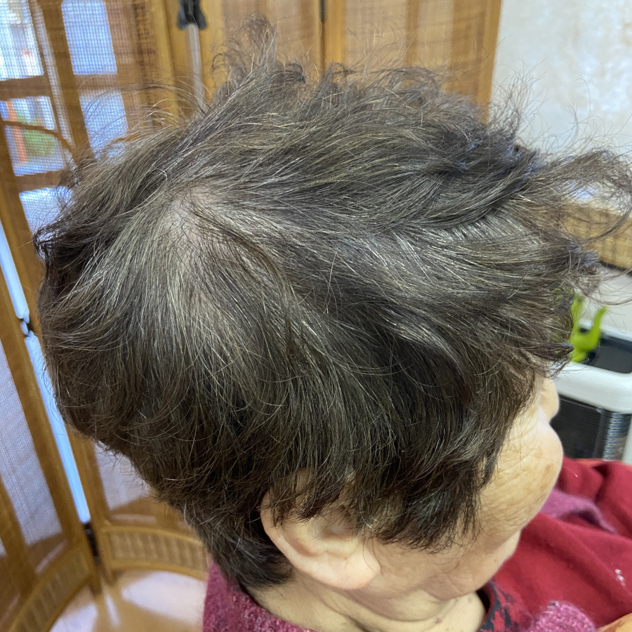 80代女性の右サイドのBefore画像